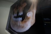 impla.cz - ZtrÃ¡ta zubu - neviditelnÃ¡ ztrÃ¡ta sebevÄdomÃ­